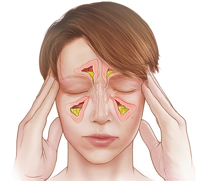 Homeopathic remedies for treating vertigo, sinusitis, and eye infections
