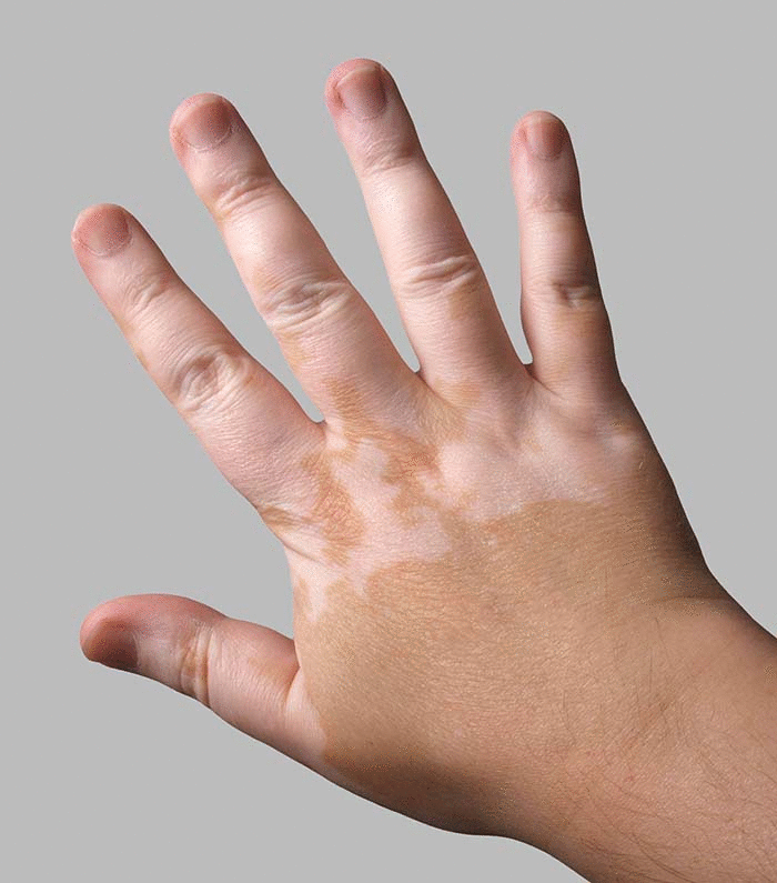 Homeopathic treatment for Vitiligo and skin depigmentation