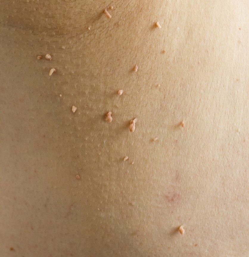 Homeopathic treatment for Warts and skin growths